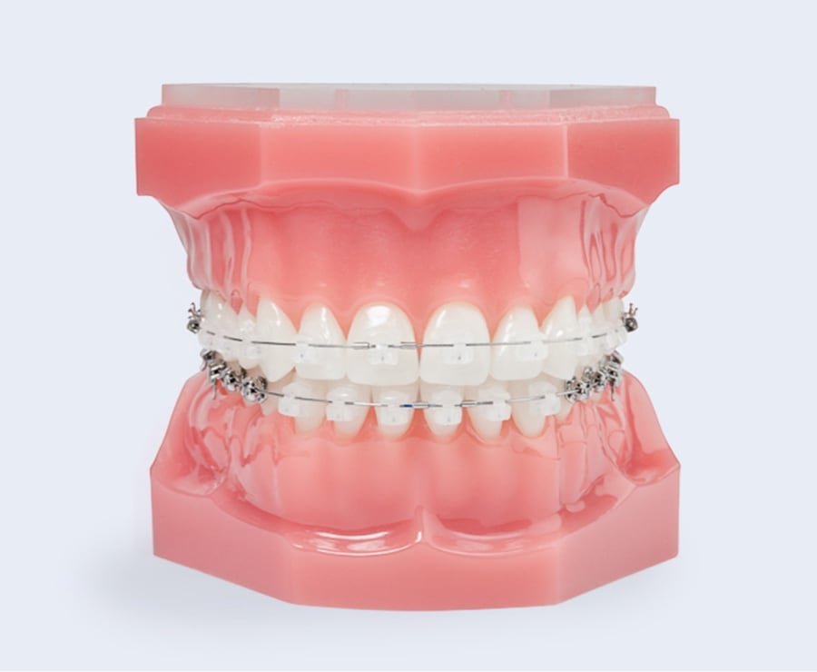 clear braces on plastic model